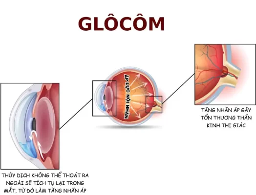 bệnh lý glocom là gì