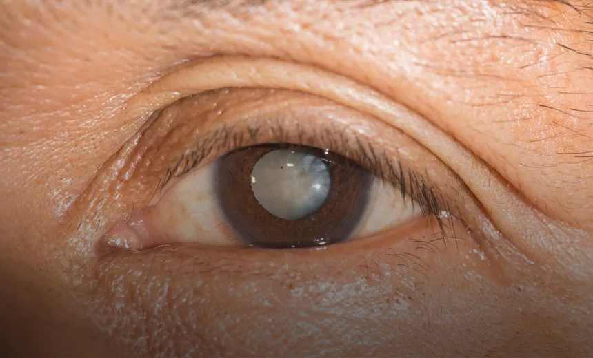 Bệnh đục thủy tinh thể – cảnh giác nguy cơ gây mù lòa hàng đầu