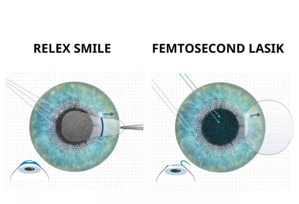 phẫu thuật tật khúc xạ bằng phương pháp relex smile và femtosecond lasik 