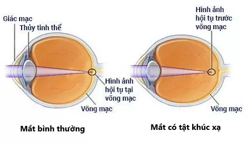 sự khác nhau ở mắt thường và mắt bị tật khúc xạ