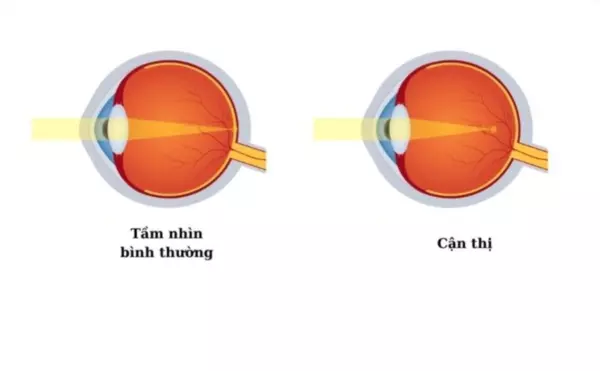 mắt bình thường và mắt cận thị