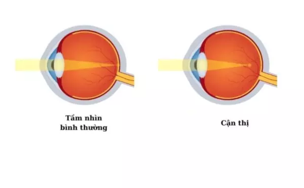sự khác nhau giữa mắt cận và mắt bình thường
