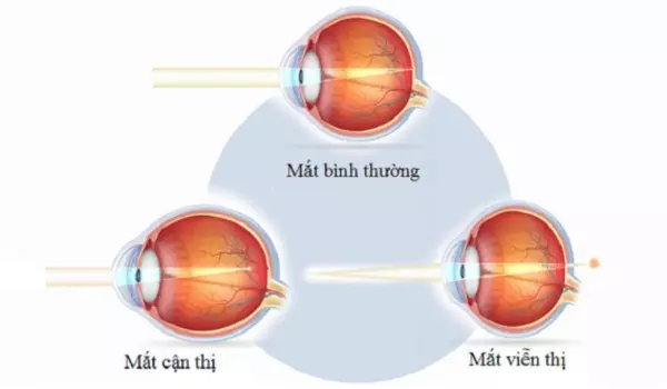 Cận thị và viễn thị khác nhau thế nào? Cách điều trị hiệu quả