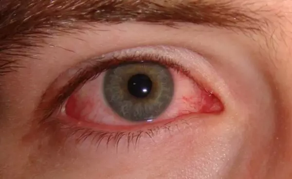 đỏ mắt là dấu hiệu của khô mắt
