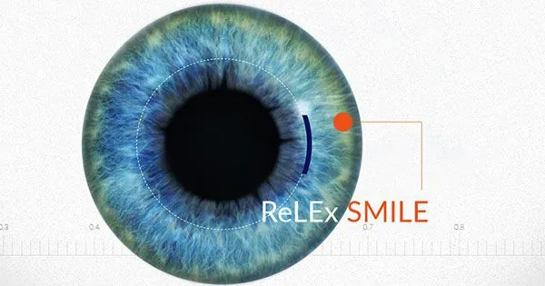 Mọi điều cần biết về ReLEx SMILE – mổ cận laser xâm lấn tối thiểu