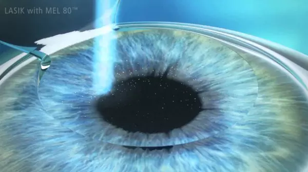 phẫu thuật mổ mắt lasik