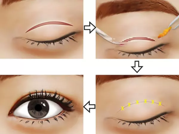 quy trình cắt mắt 2 mí