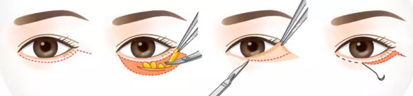 quy trình phẫu thuật lấy mỡ mí mắt dưới