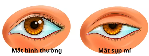 cách chữa sụp mí mắt đơn giản tại nhà