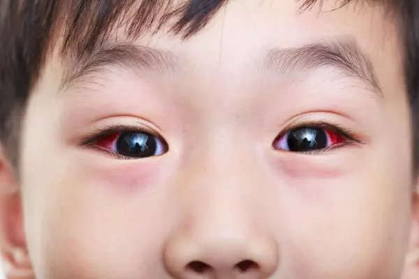 đỏ mắt do tụ máu sau mổ lác
