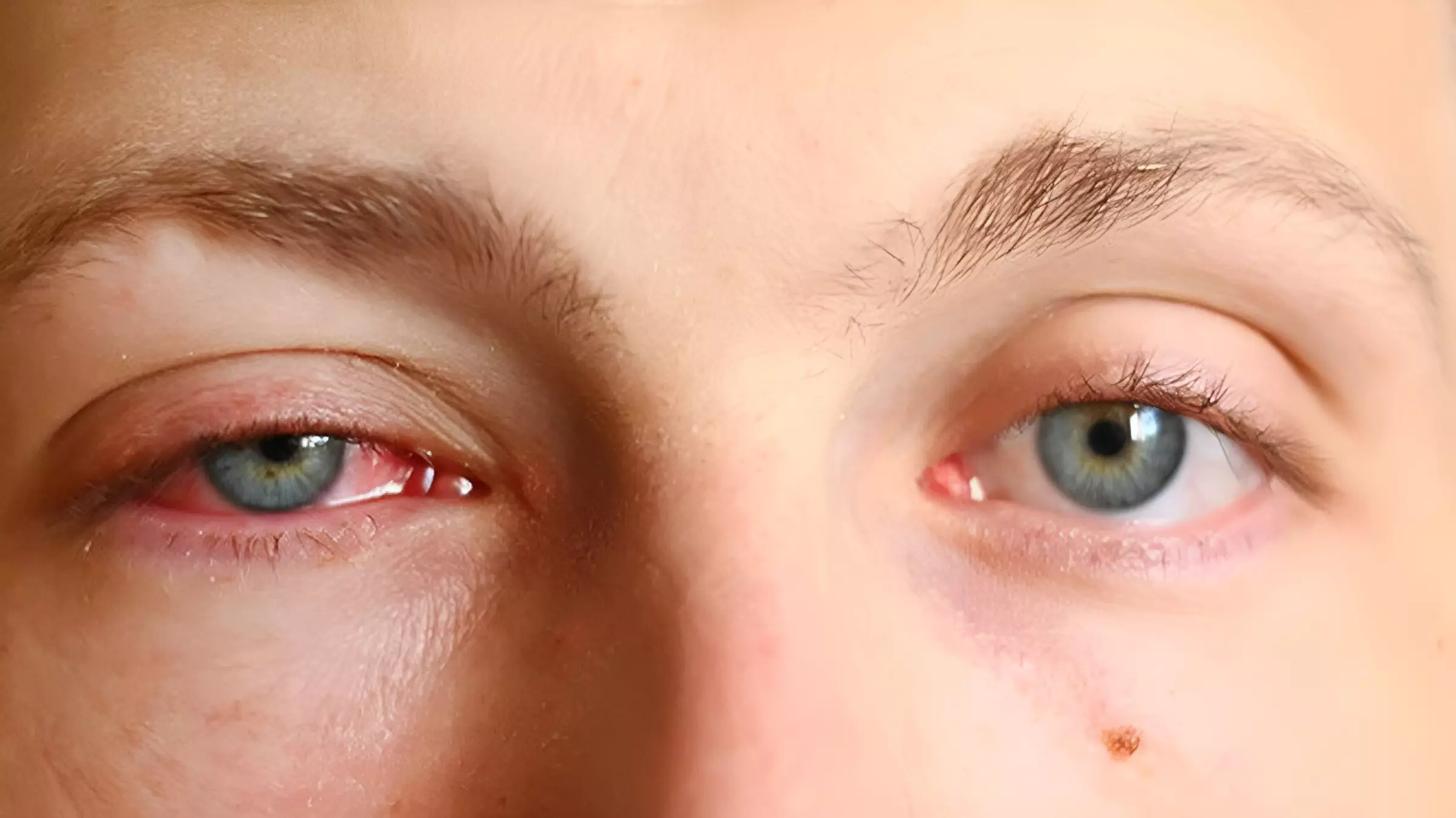 Bệnh cườm mắt là gì? Tìm hiểu chi tiết và phương pháp phẫu thuật hiệu quả