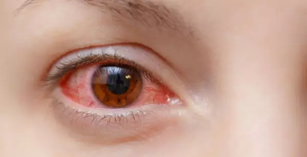 bệnh viêm giác mạc ở mắt 