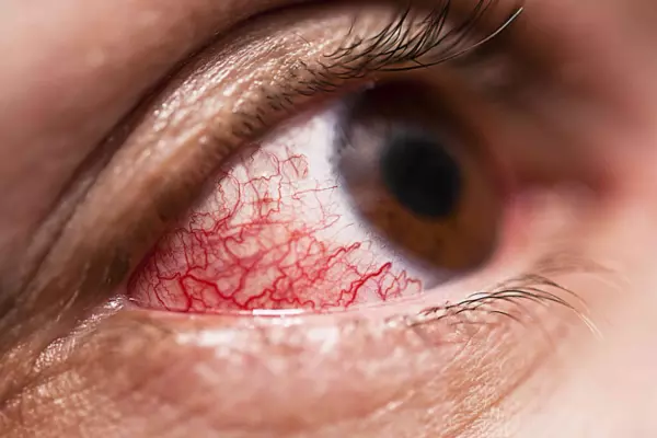 bệnh viêm màng bồ đào ở mắt