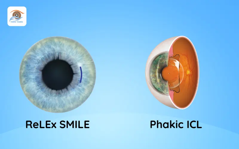 relex smile và phakic icl