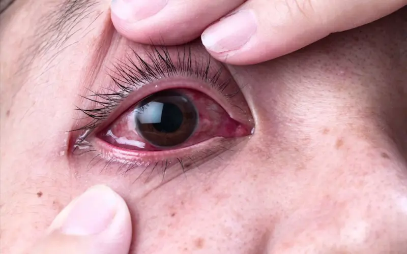 Thực hư việc mắt dễ bị viêm kết mạc sau mổ Lasik