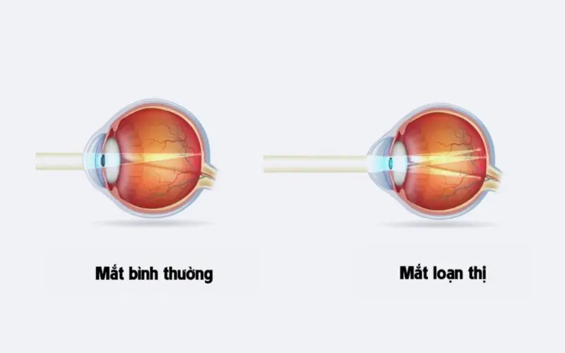 mắt loạn thị là gì