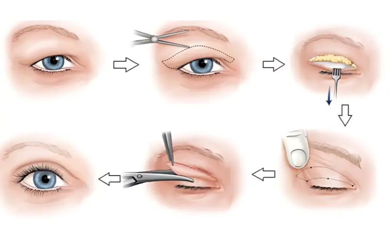 quy trình phẫu thuật cắt da thừa mí mắt