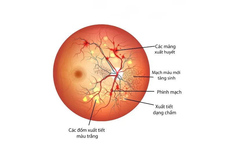 bệnh võng mạc tiểu đường