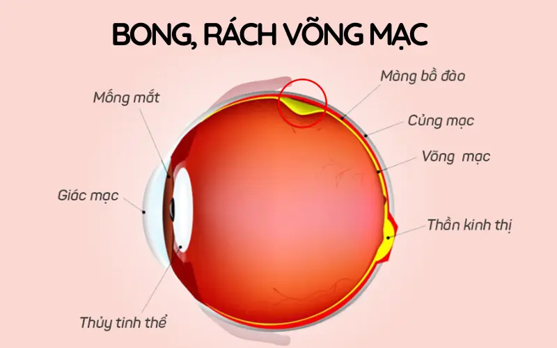 biến chứng bong rách võng mạc ở mắt