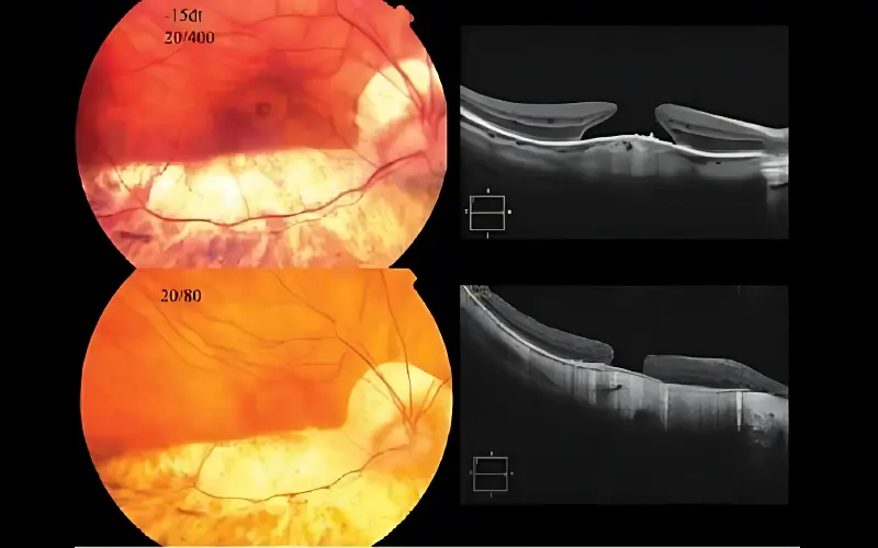 thoái hóa võng mạc chu biên
