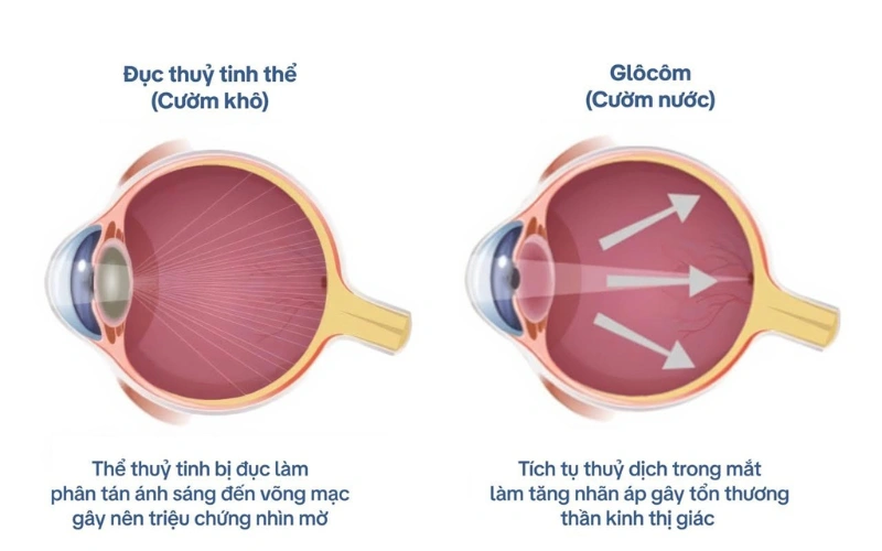 tổng quan về cườm mắt