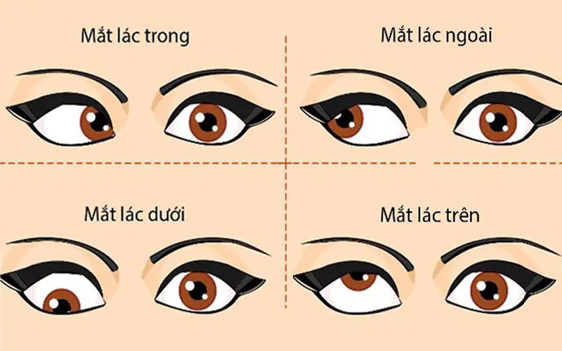 tổng quan về mắt lác