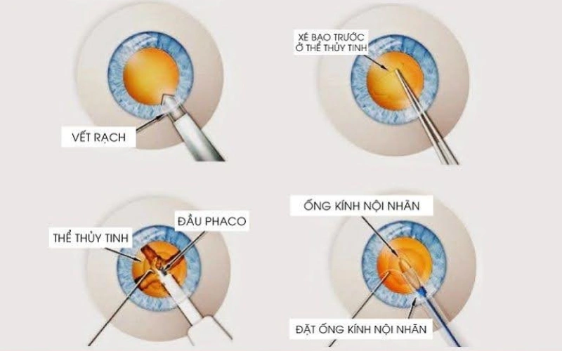 phaco là công nghệ phổ biến nhất với cườm khô