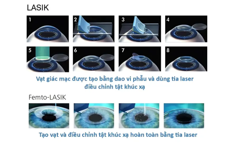 phẫu thuật lasik và femto lasik