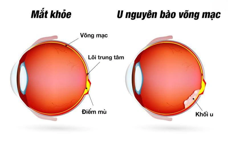 u nguyên bào võng mạ