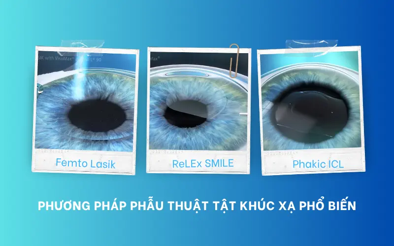 Ưu nhược điểm các phương pháp mổ cận: Chọn đúng phương pháp – Nhìn rõ lâu dài