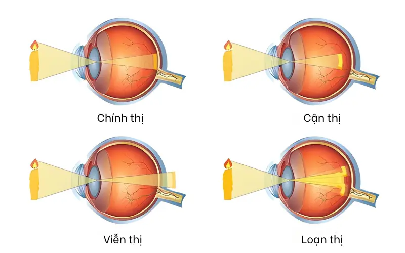 vừa cận thị vừa loạn thị có mổ được không