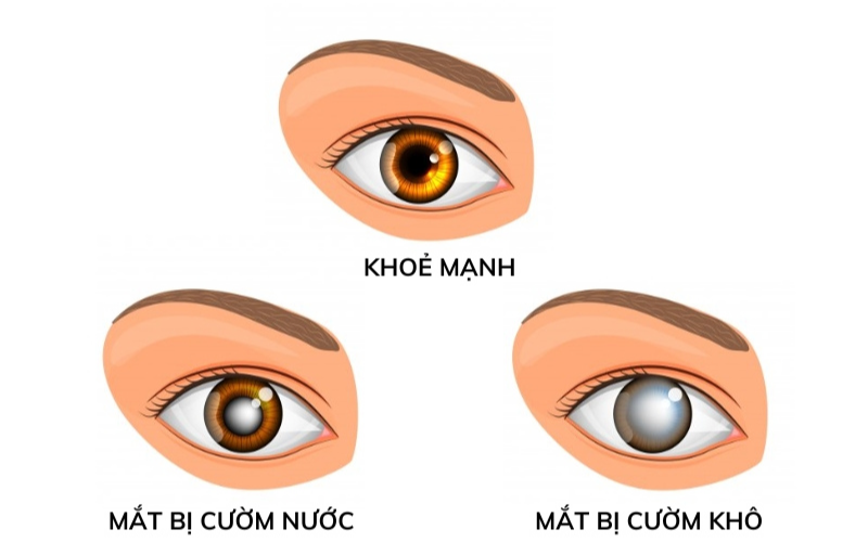 bệnh cườm mắt là gì