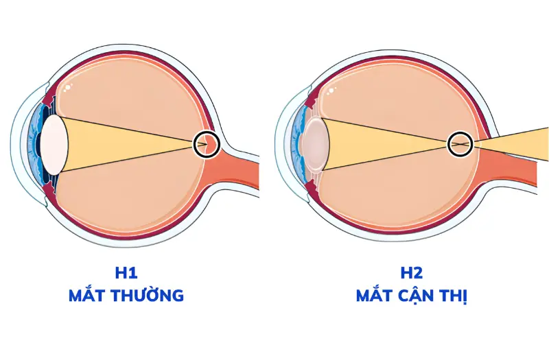 cận thị là gì