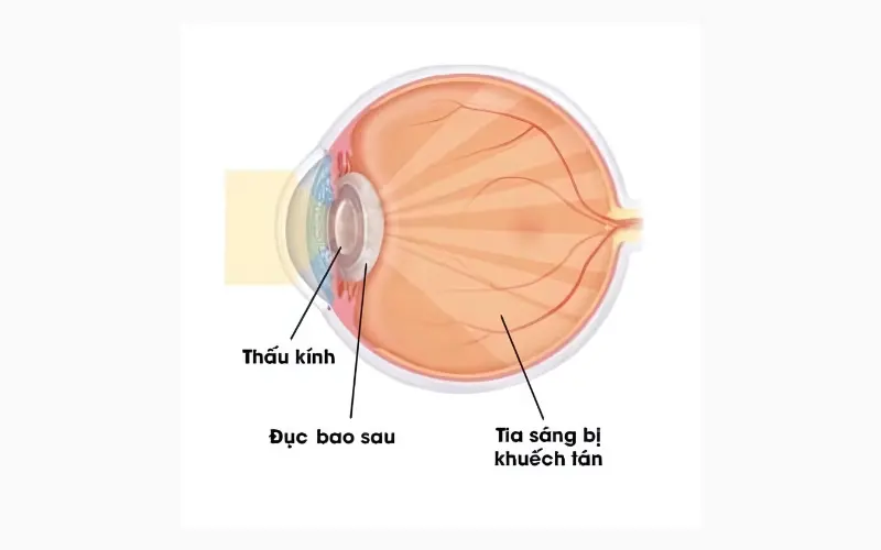 đục bao sau