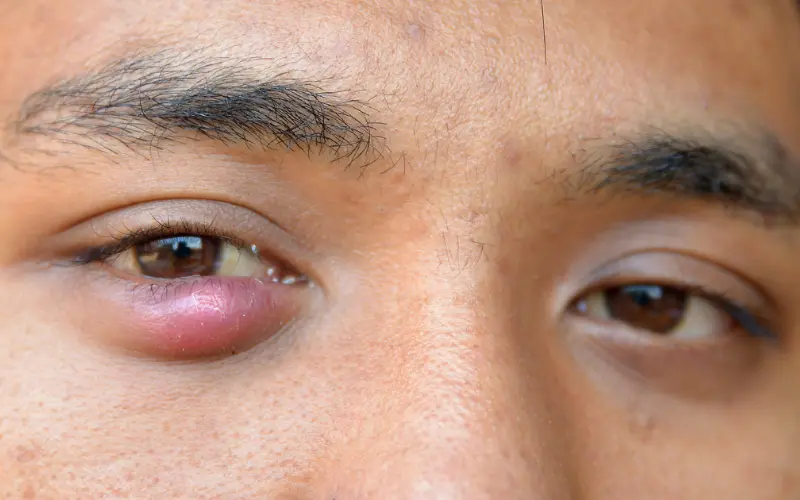 lẹo mắt sưng to