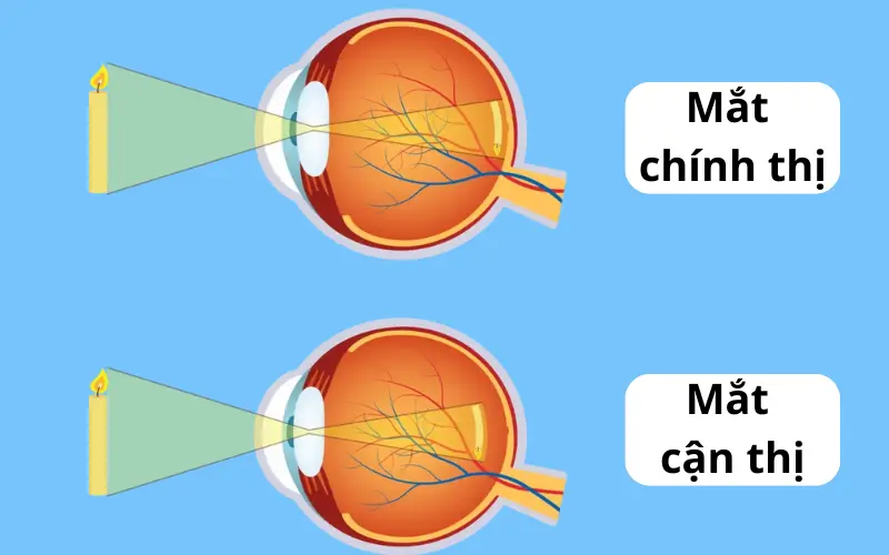 mắt cận thị