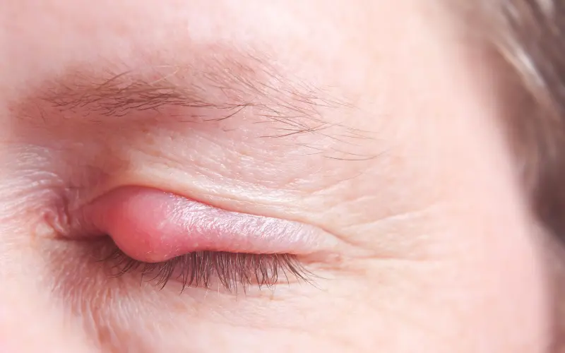 mổ lẹo mắt bao lâu thì khỏi
