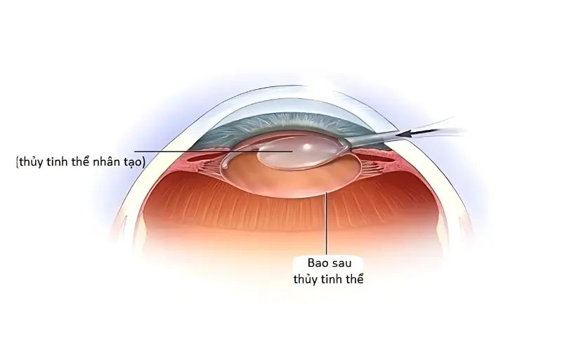 vị trí bao sau ở thủy tinh thể