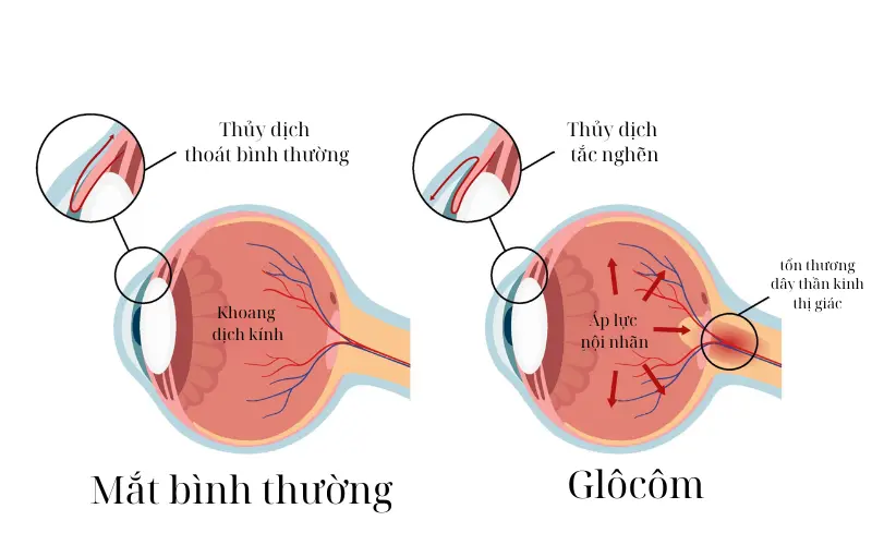 bệnh Glôcôm có chữa được không