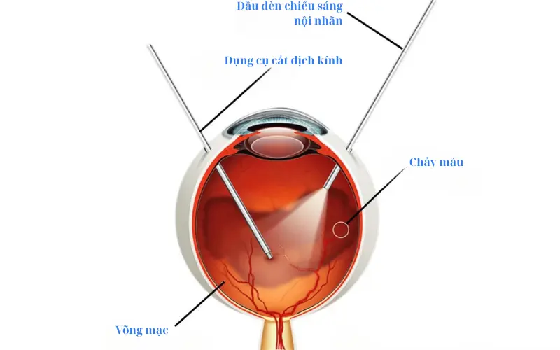 cắt dịch kính