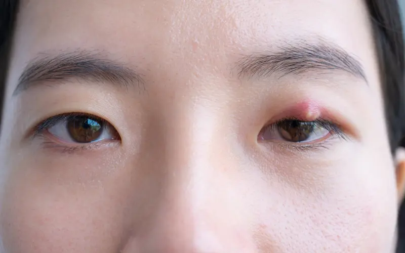 Lẹo mắt là gì? Nguyên nhân, triệu chứng và cách điều trị