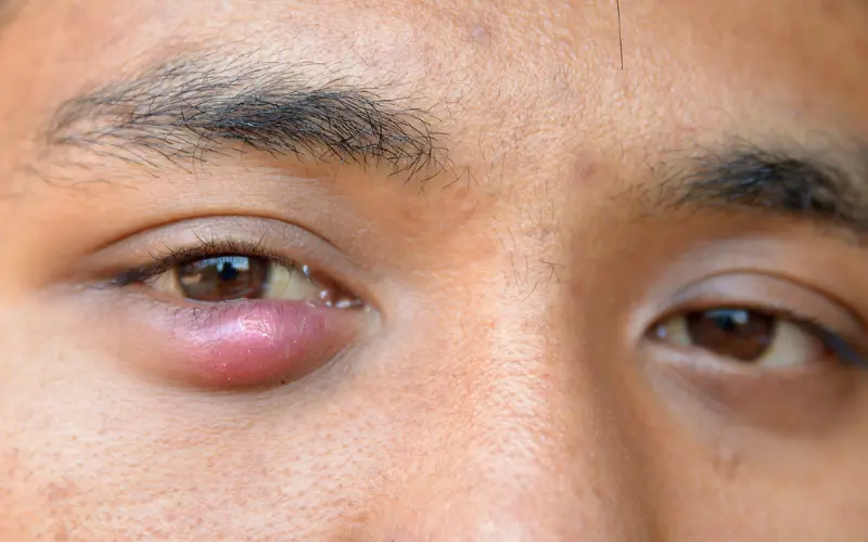 lẹo mắt sưng đỏ