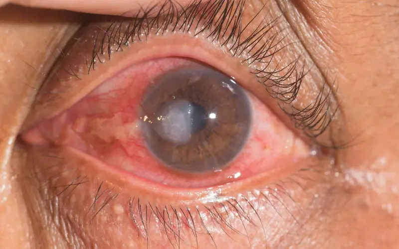 Loét giác mạc do nấm: Những điều cần biết và cách điều trị kịp thời