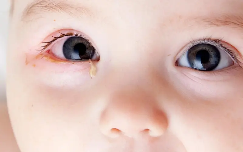 mắt có dịch mủ màu xanh