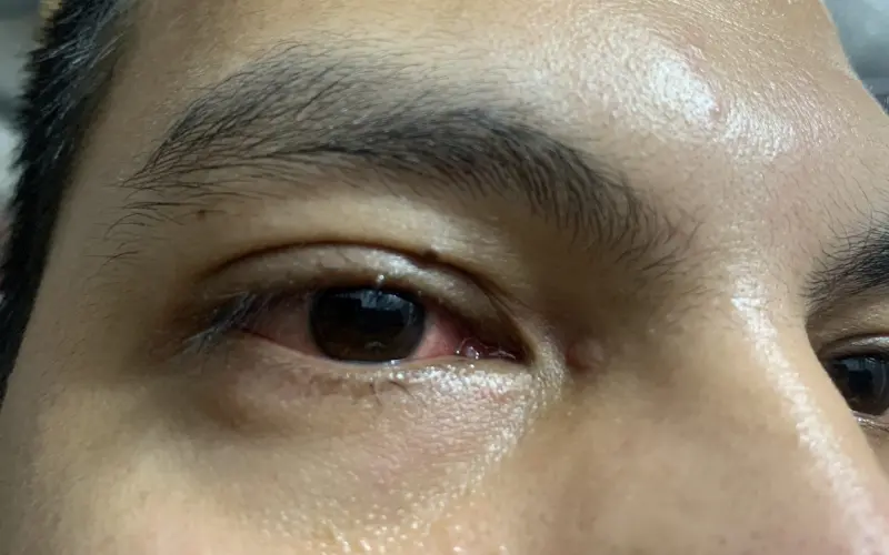 mắt cộm đỏ