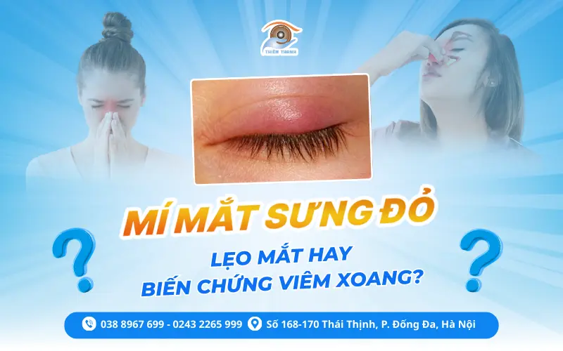 Mí mắt sưng đỏ – Lẹo mắt hay biến chứng nguy hiểm từ viêm xoang?