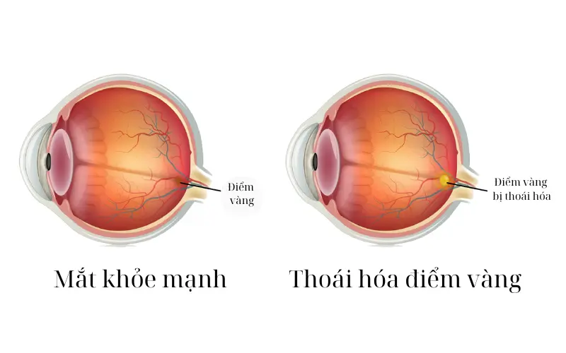 thoái hóa điểm vàng là gì