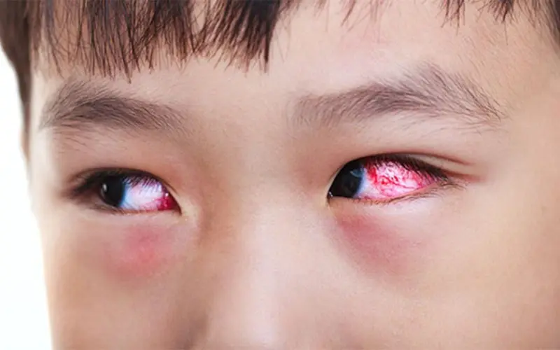 Viêm kết mạc mắt ở trẻ em: Nguyên nhân, triệu chứng và cách chăm sóc hiệu quả