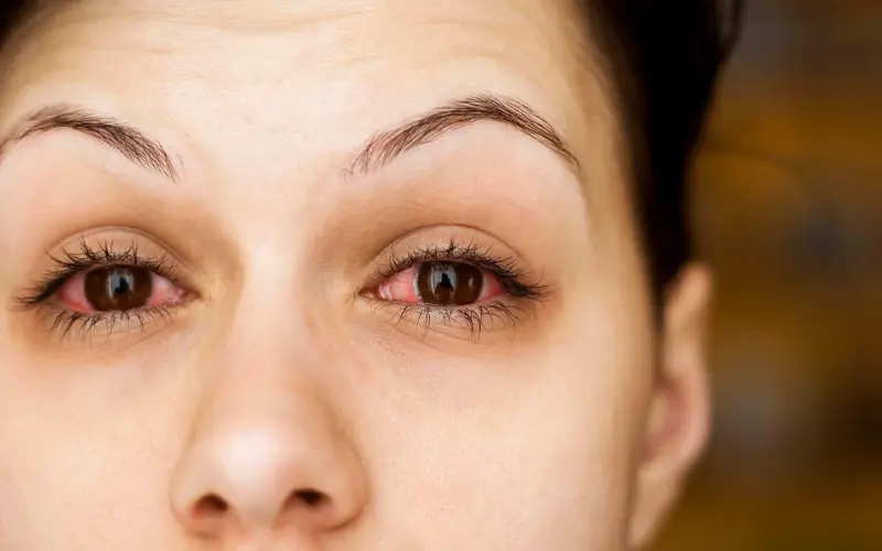 Bệnh đau mắt đỏ: Triệu chứng, nguyên nhân và cách điều trị an toàn