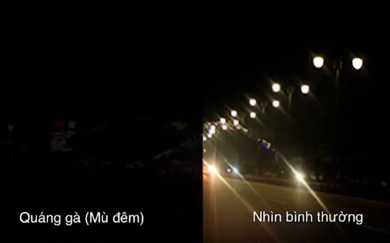 bệnh quáng gà